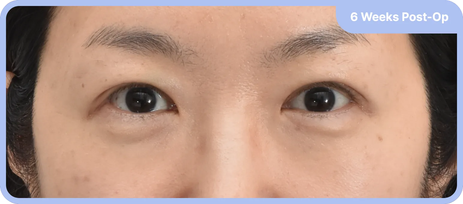 Post-upper blepharoplasty and double eyelid surgery - achieving a natural and youthful look