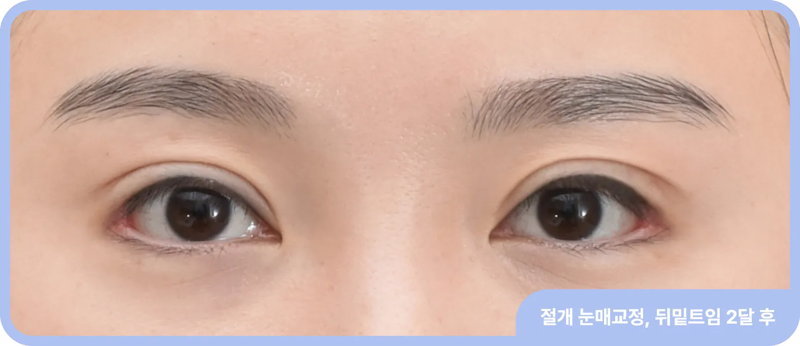 뒤밑트임 후 모습