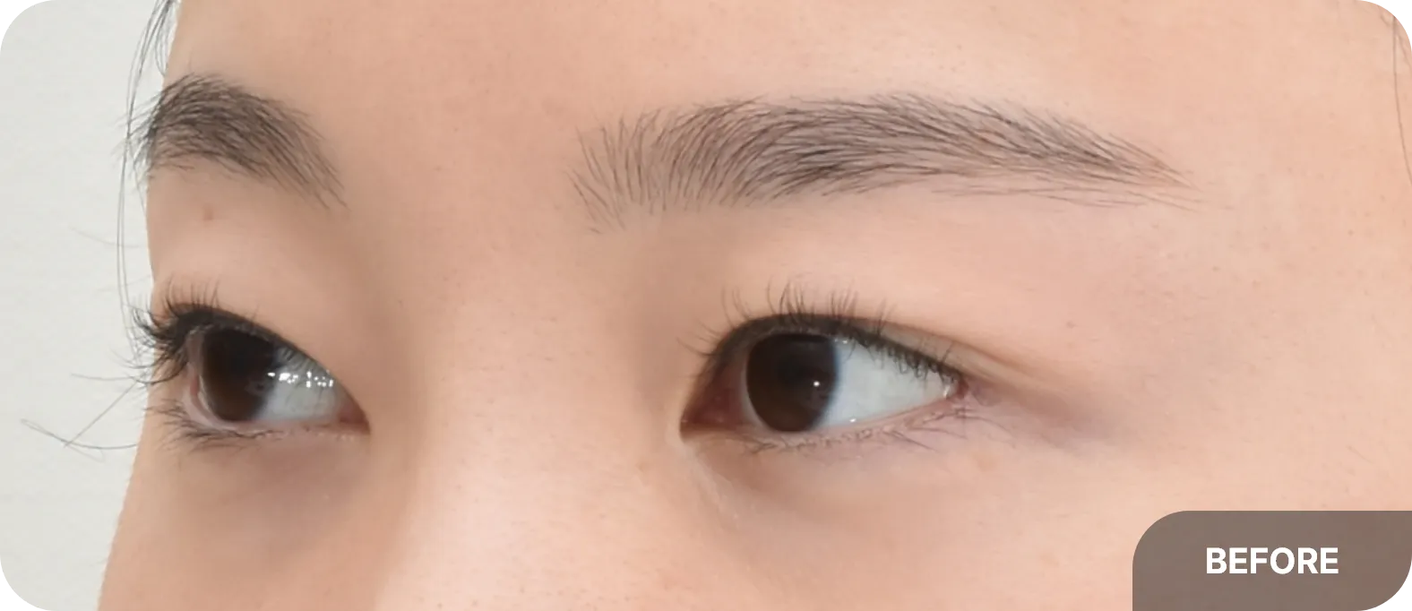 뒤트임 전후