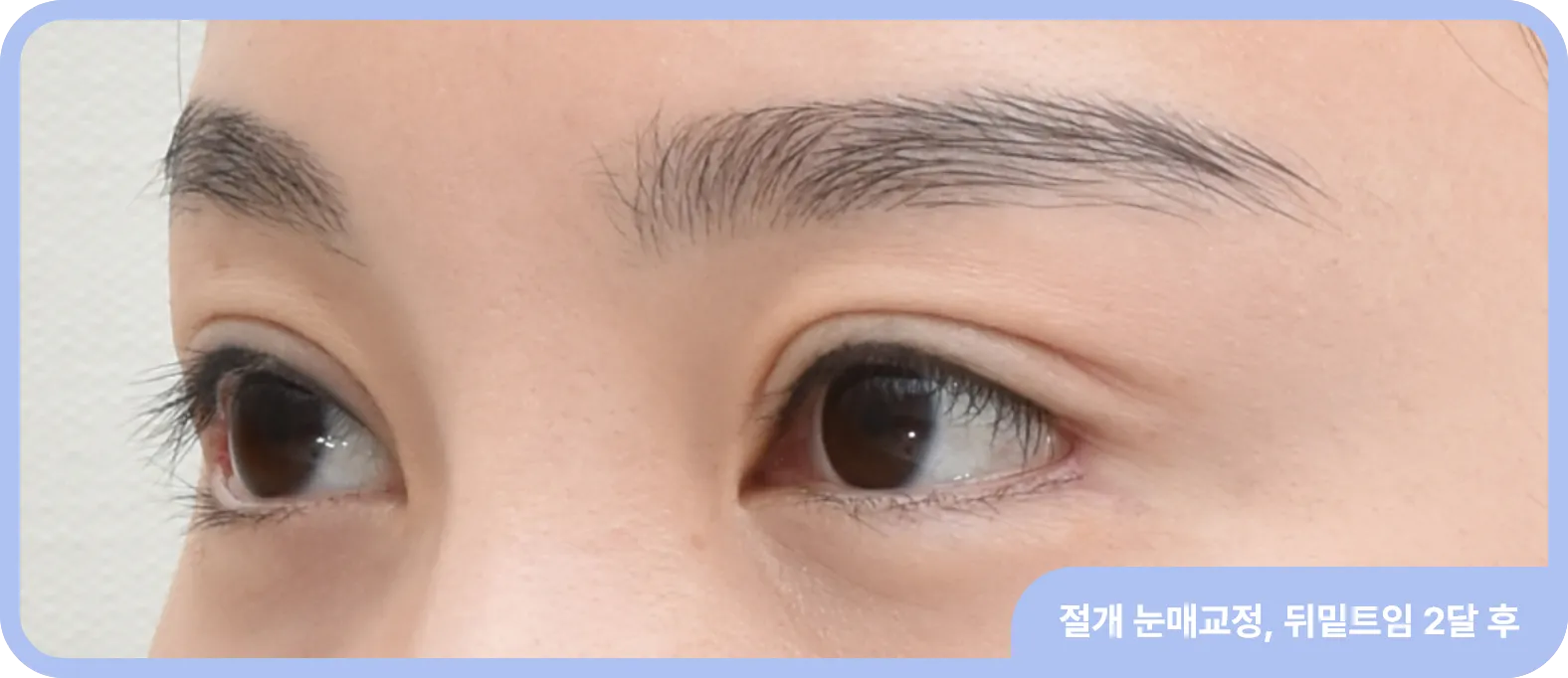 밑트임 전후