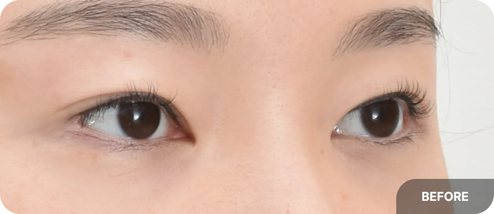 lateral canthoplasty before