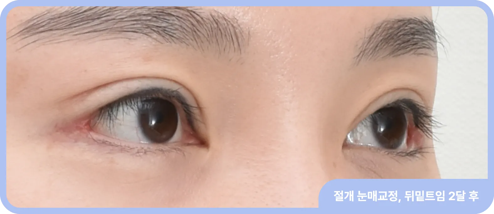 뒤트임 흉터