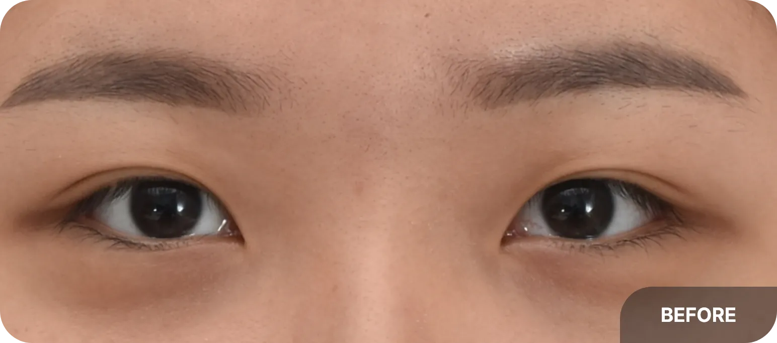 몽고주름이 있는 모습