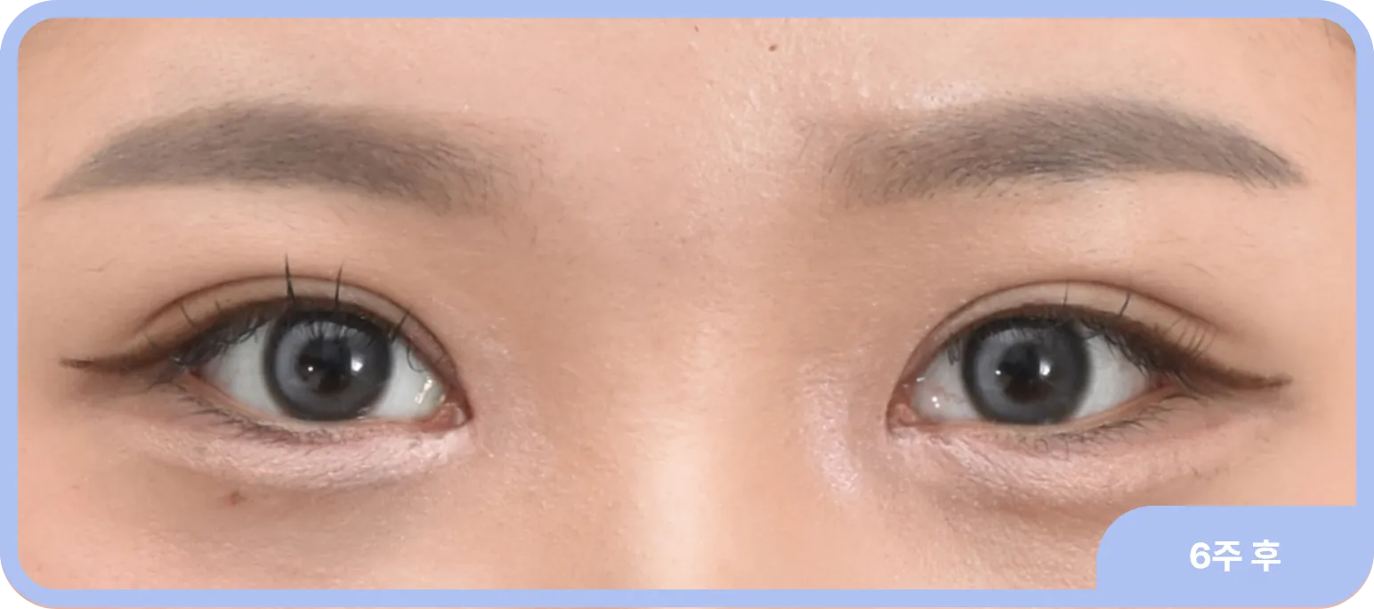 앞트임으로 몽고주름을 개선