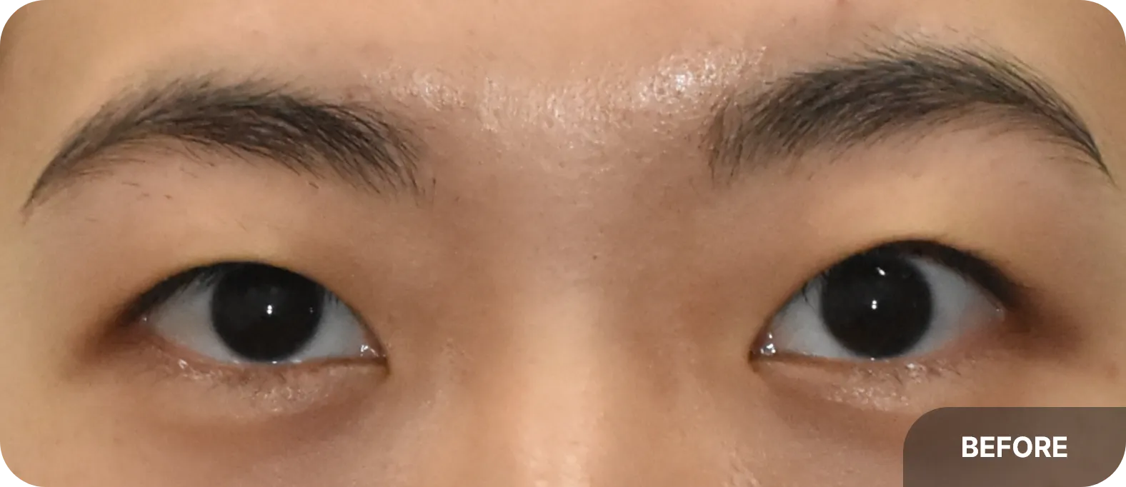 uneven eyes correction before
