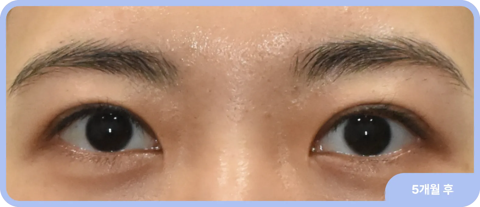 짝눈교정 시행한 후