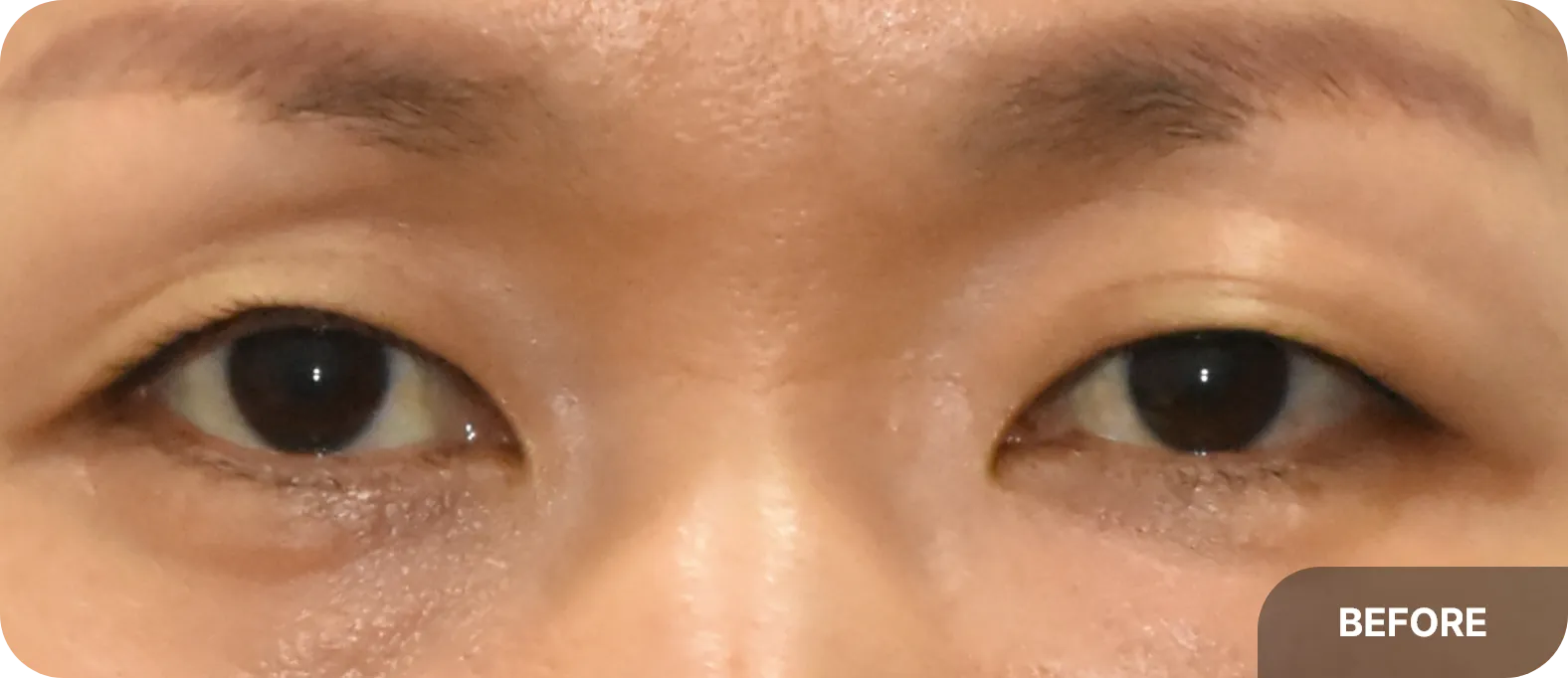 ptosis correction before