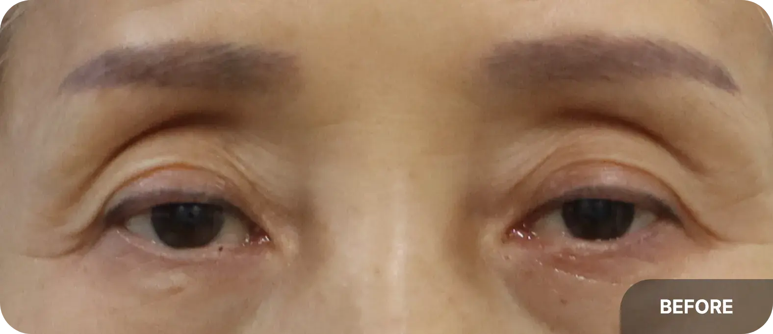 Features of aging eyelids