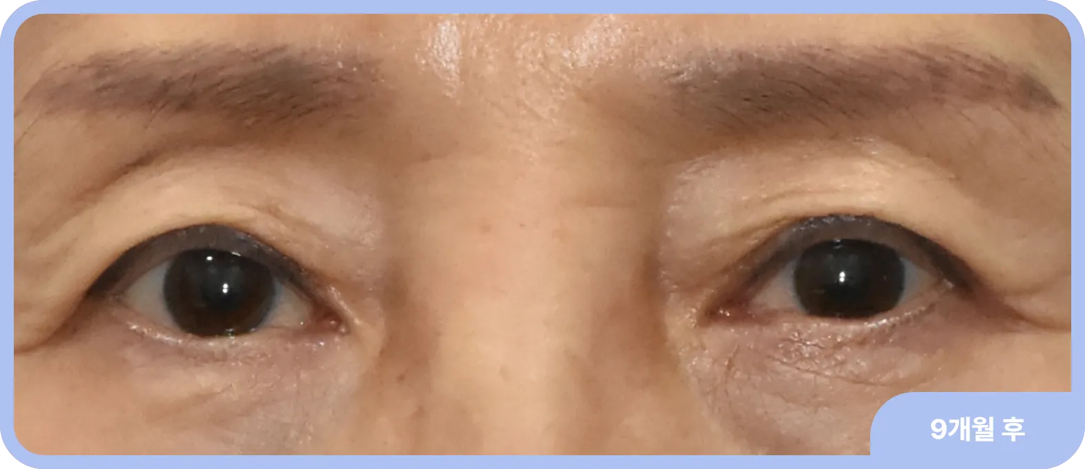 중년눈성형에도 눈매교정의 역할이 매우 중요