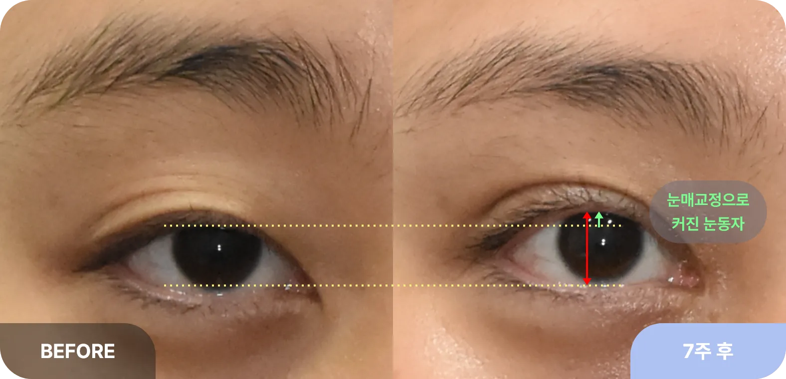 눈매교정의 효과 - 검은 눈동자가 더 커지는 눈성형