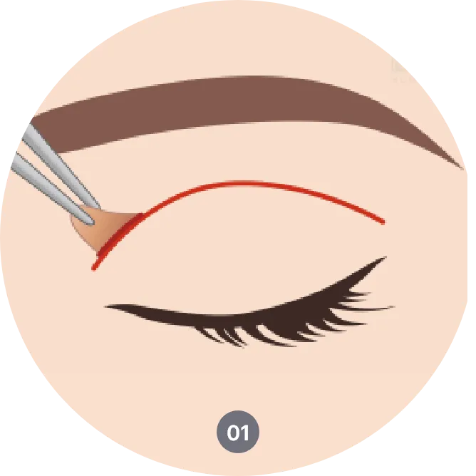 How ptosis surgery is done - lifting drooping eyelids through tightening the muscle
