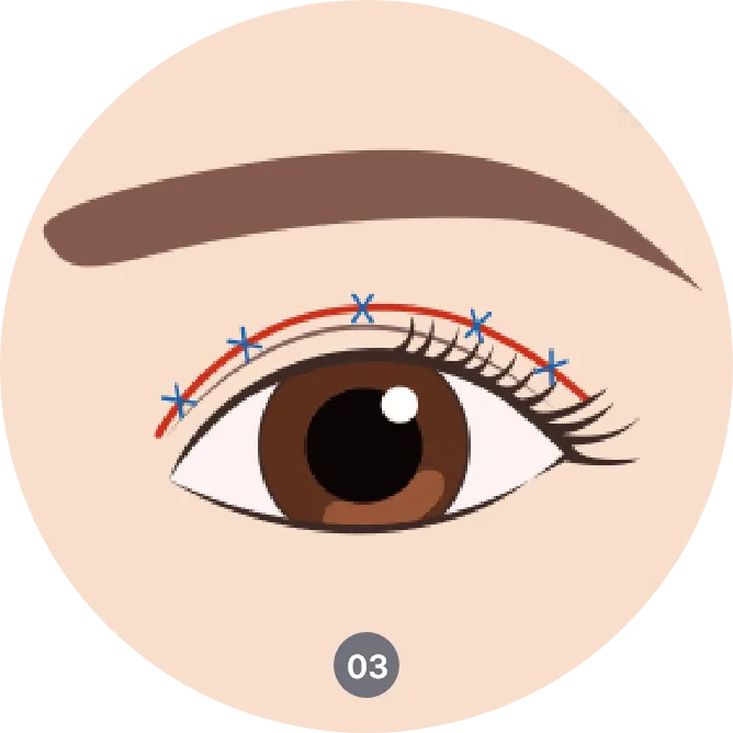 How ptosis surgery is done - lifting drooping eyelids through tightening the muscle