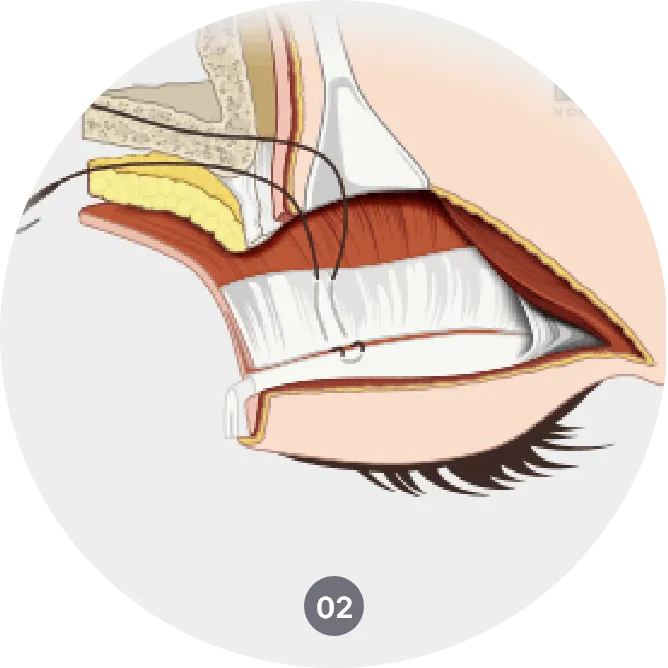 How ptosis surgery is done - lifting drooping eyelids through tightening the muscle