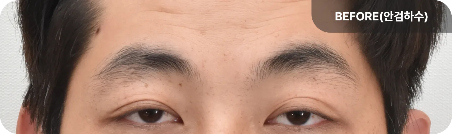 심한 졸린눈으로 동공이 절반이상 덮인 30대 남자 - 수술 전