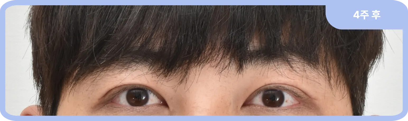 안검하수 교정 4주 후 모습
