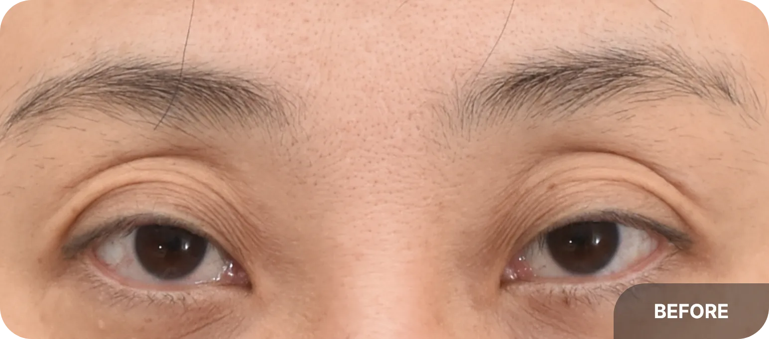 Aging eyelids with high folds, sleepy appearance, and multiple creases - requiring ptosis correction