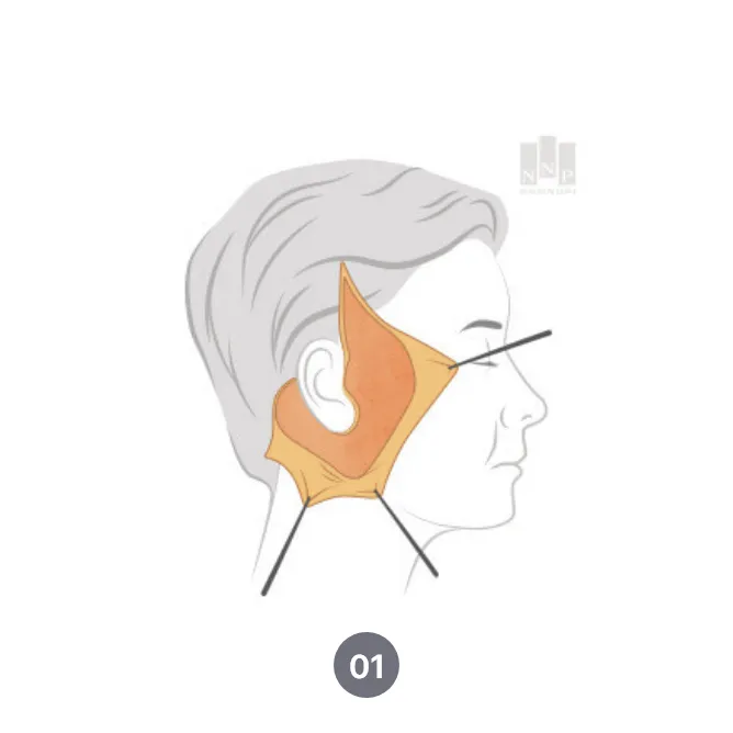 SMAS facelift procedure in Noonopi Plastic Surgery