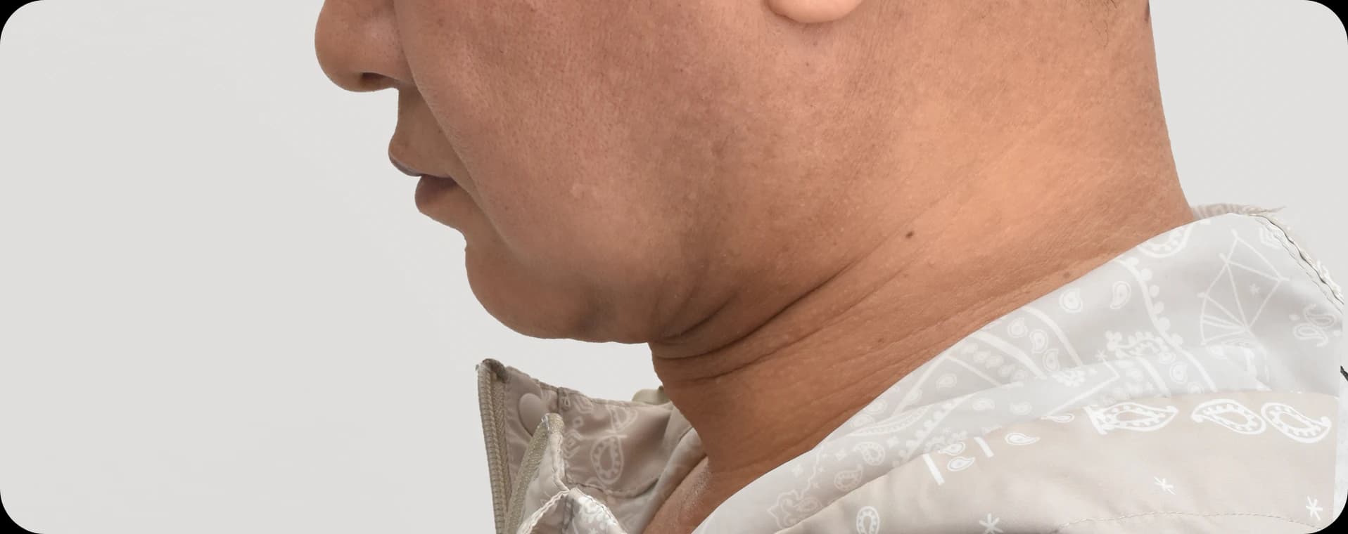Before and after double chin surgery - achieving a slimmer, more youthful jawline