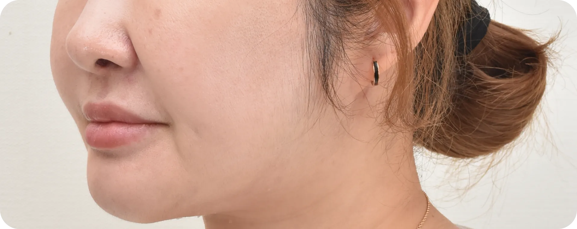 Before and after double chin surgery - achieving a slimmer, more youthful jawline