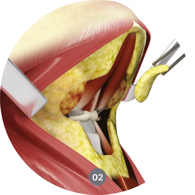 neck lift procedure in Korea