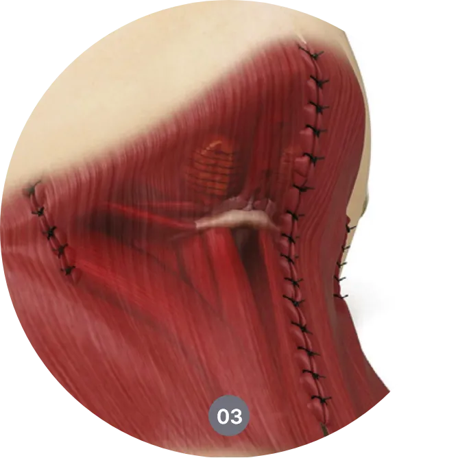 neck lift procedure in Korea