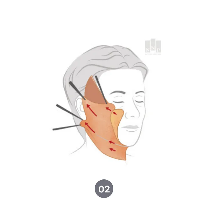 SMAS facelift procedure in Noonopi Plastic Surgery