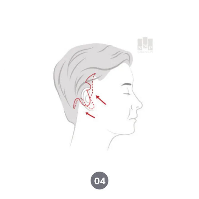 SMAS facelift procedure in Noonopi Plastic Surgery