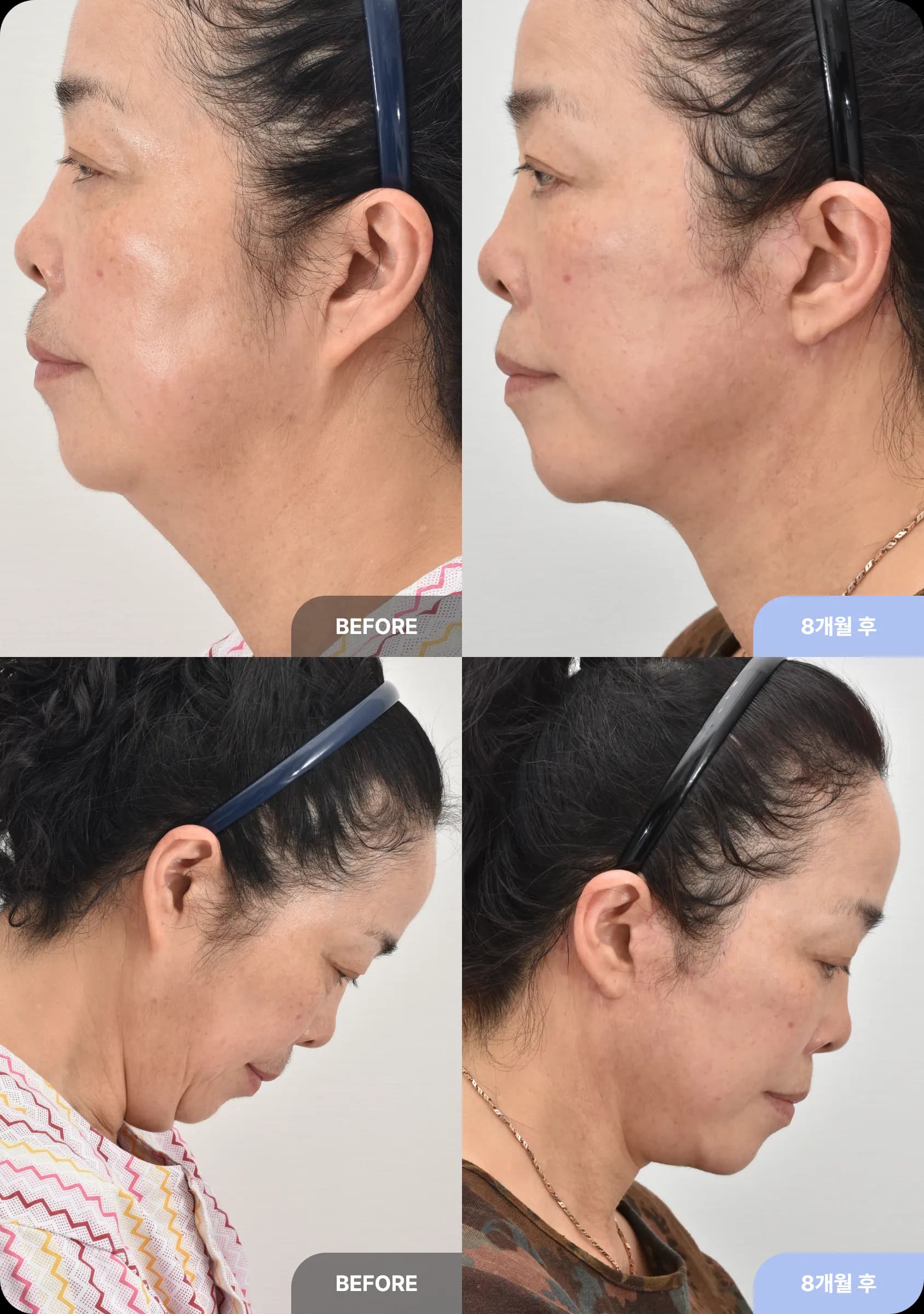 눈높이 성형외과 안면거상의 4가지 특징 - 2. 자연스러운 헤어라인