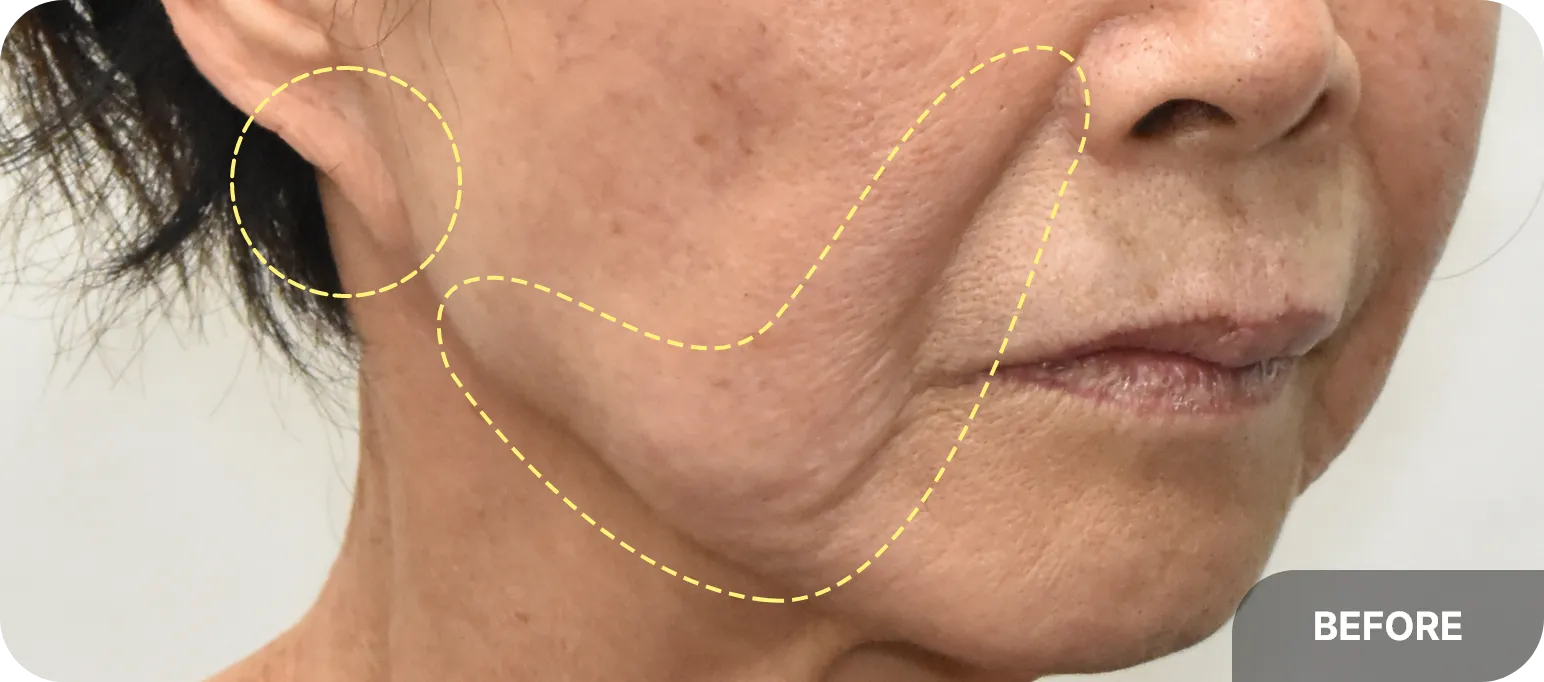 Facelift side effect - pixie ear caused by changes in ear contours after surgery