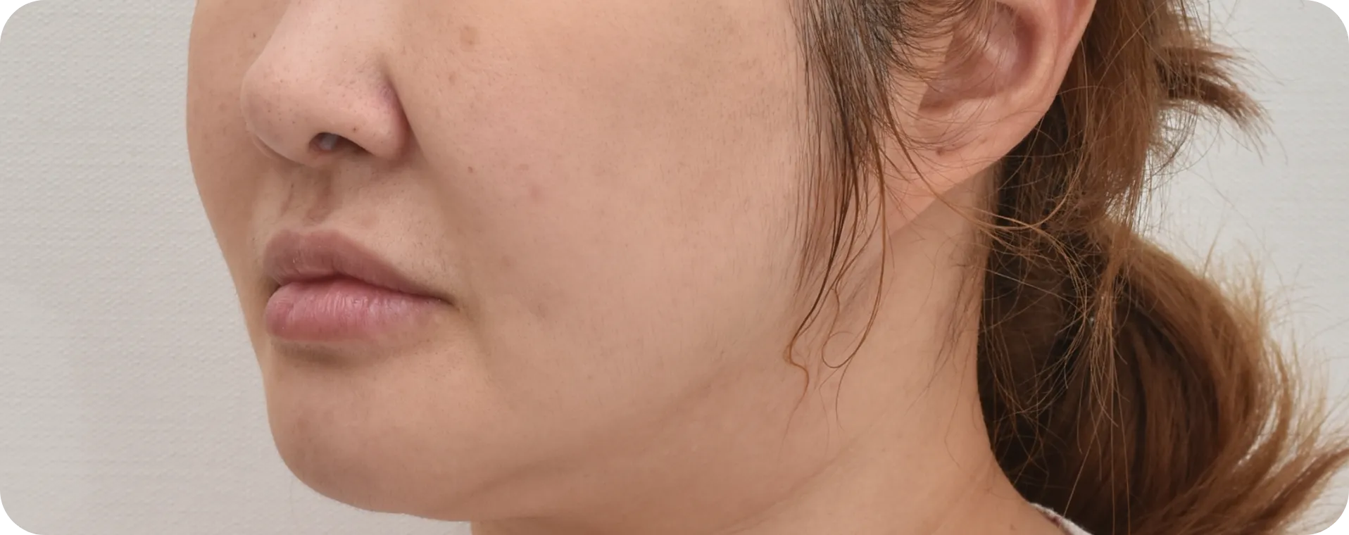 Pre-neck lift - visible double chin and excess skin around the neck area