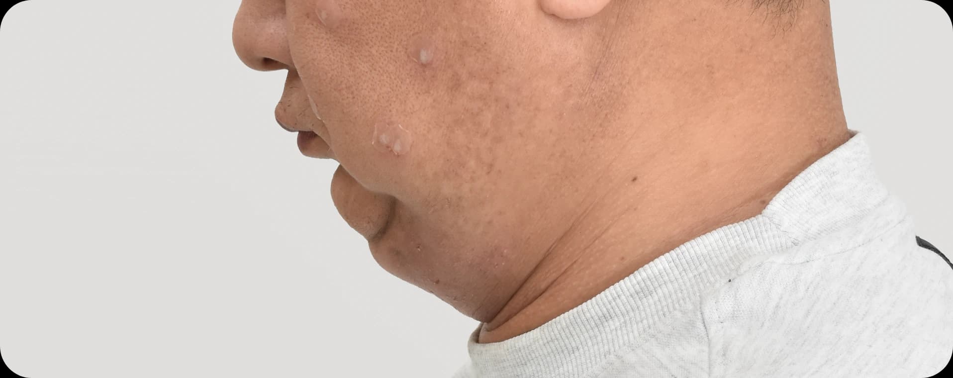 Pre-neck lift - visible double chin and excess skin around the neck area