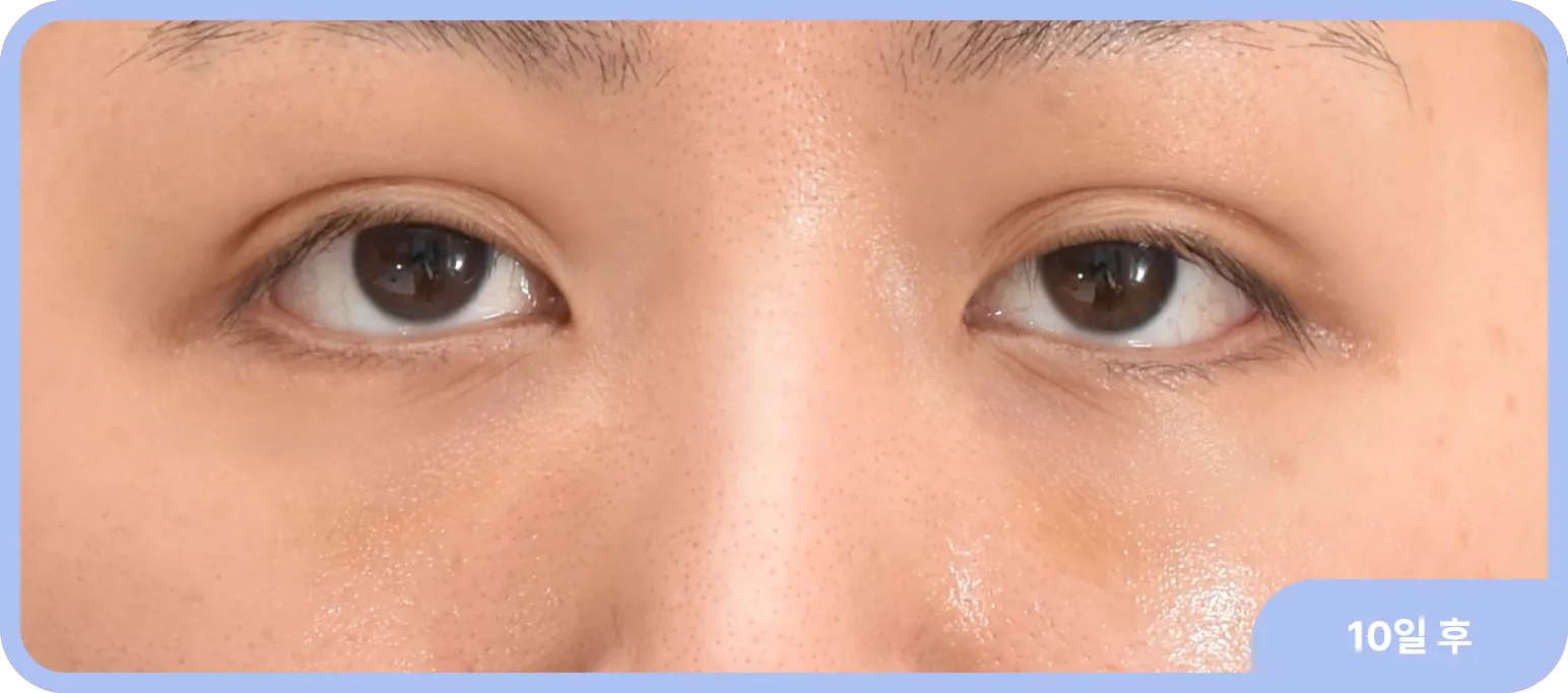 아이홀지방이식으로 눈 위 꺼짐을 채우고 자연스러운 눈매 완성