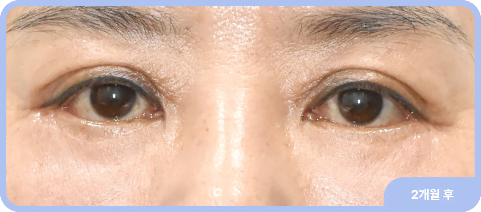 지방이식과 하안검 재수술로 젊어진 눈 밑