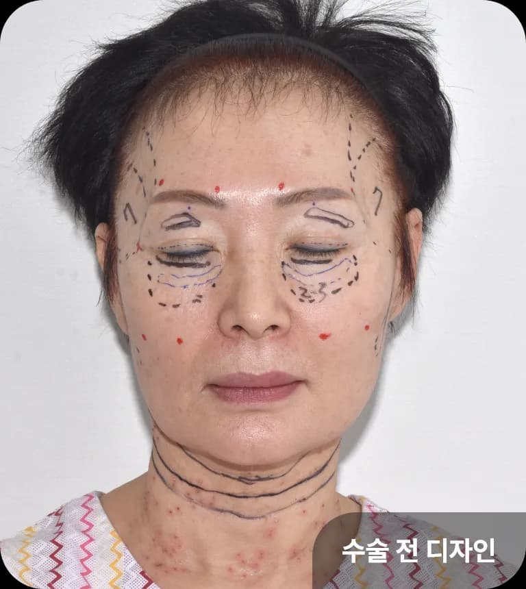 나노지방이식