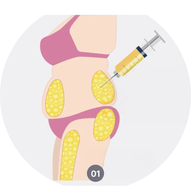 fat injection procedure