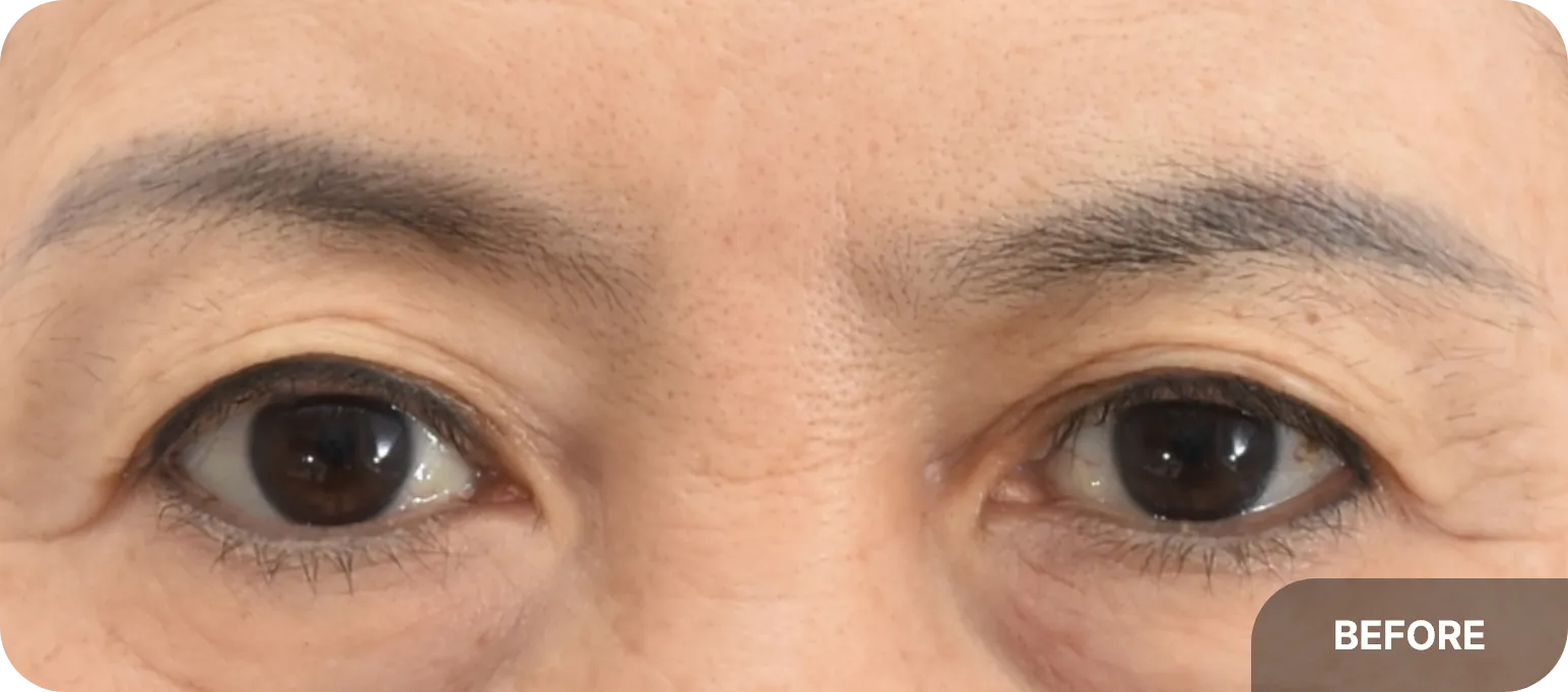 Before brow lift surgery - drooping brows and wrinkles on the upper eyelids