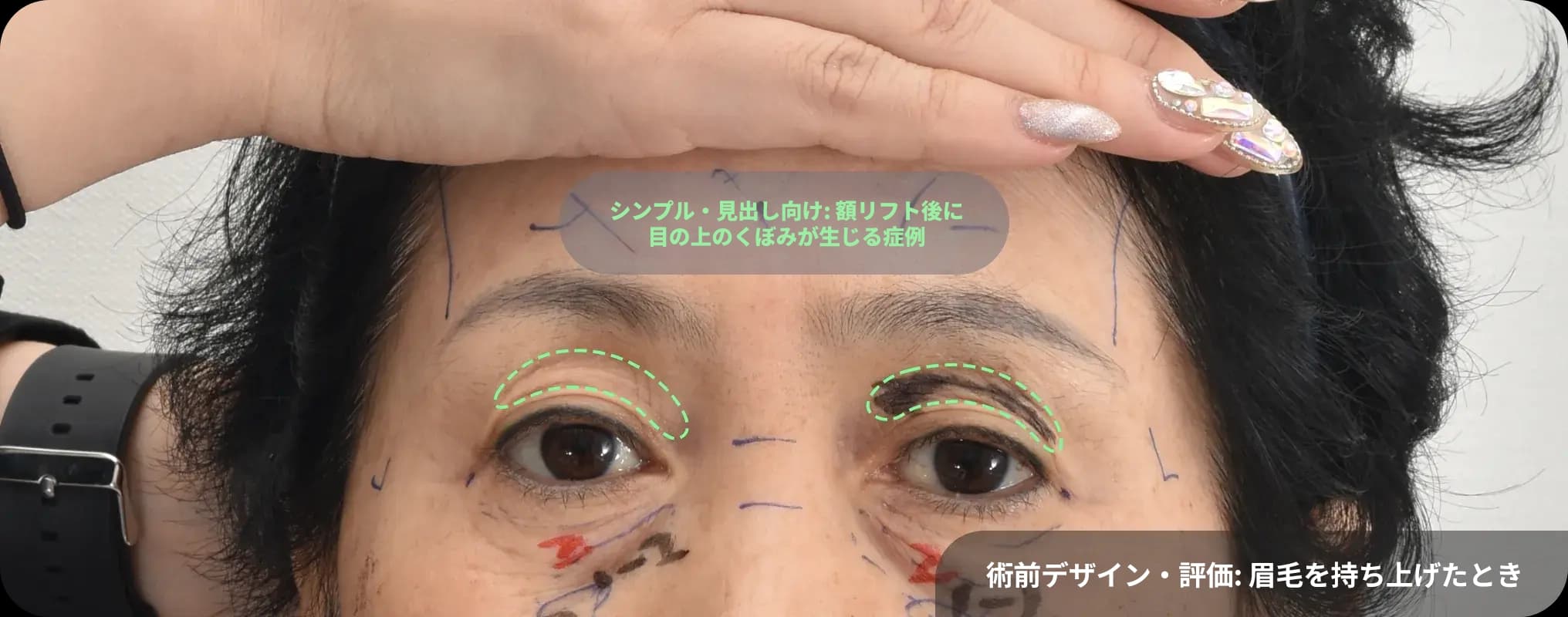 Post-endoscopic forehead lift with upper lid fat graft - refreshed appearance with lifted brows and reduced wrinkles