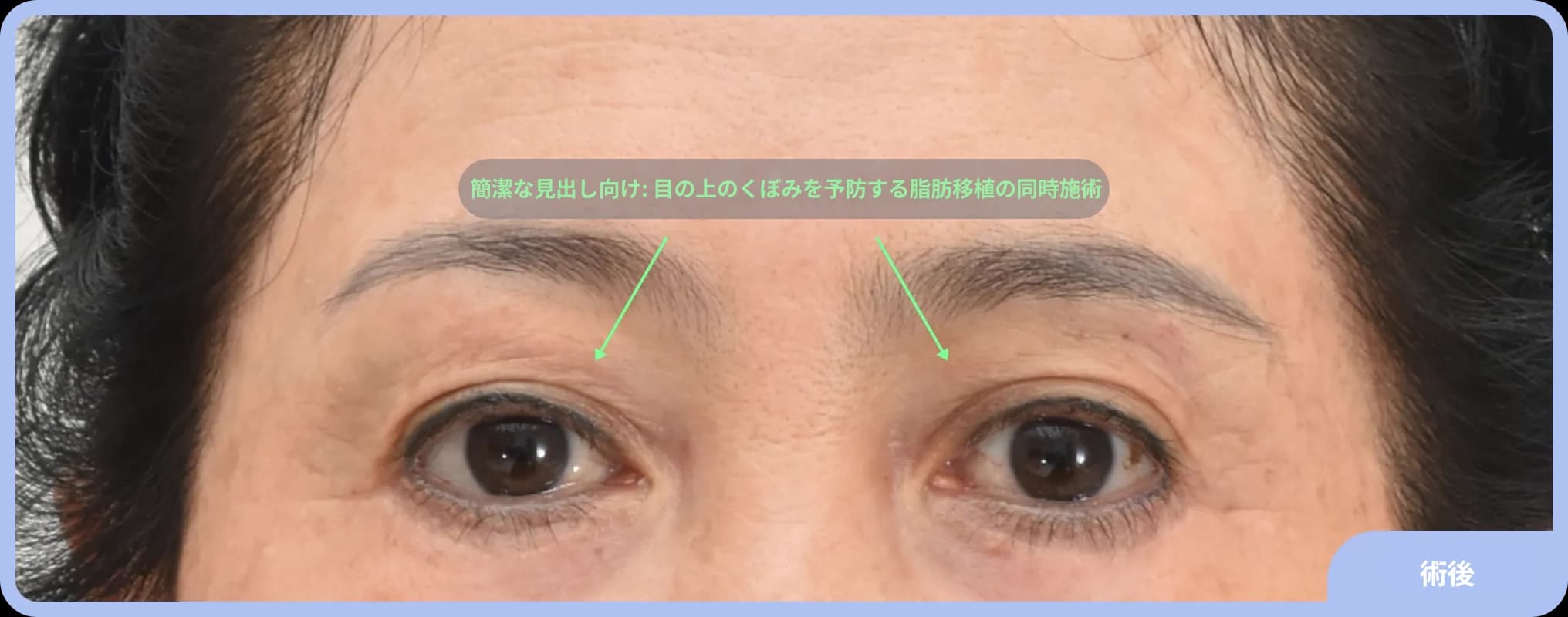 Post-endoscopic forehead lift with upper lid fat graft - refreshed appearance with lifted brows and reduced wrinkles