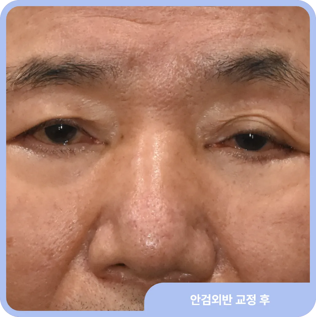 눈높이성형외과에서 안검외반을 잘 치료한 모습