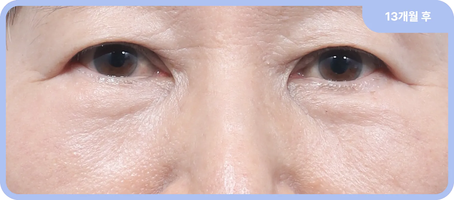 눈높이성형외과 하안검 및 지방이식 후 1년 이상 좋은 결과가 잘 유지되는 모습