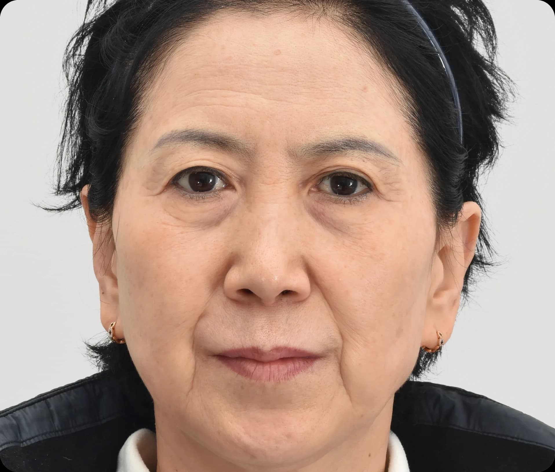 눈 밑 꺼짐이 심한 60대 여성 - 하안검 및 지방이식 수술 전 모습