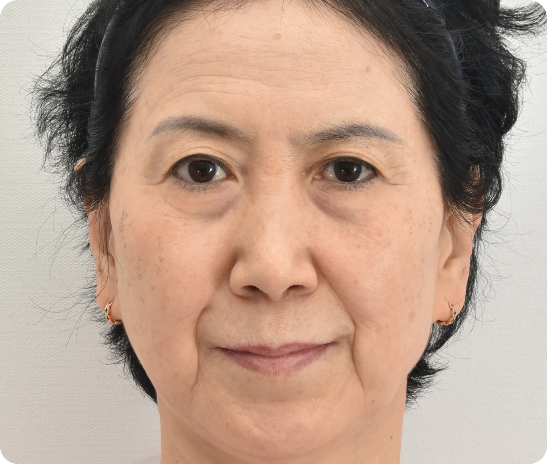 Before lower blepharoplasty - under-eye wrinkles and eyebags