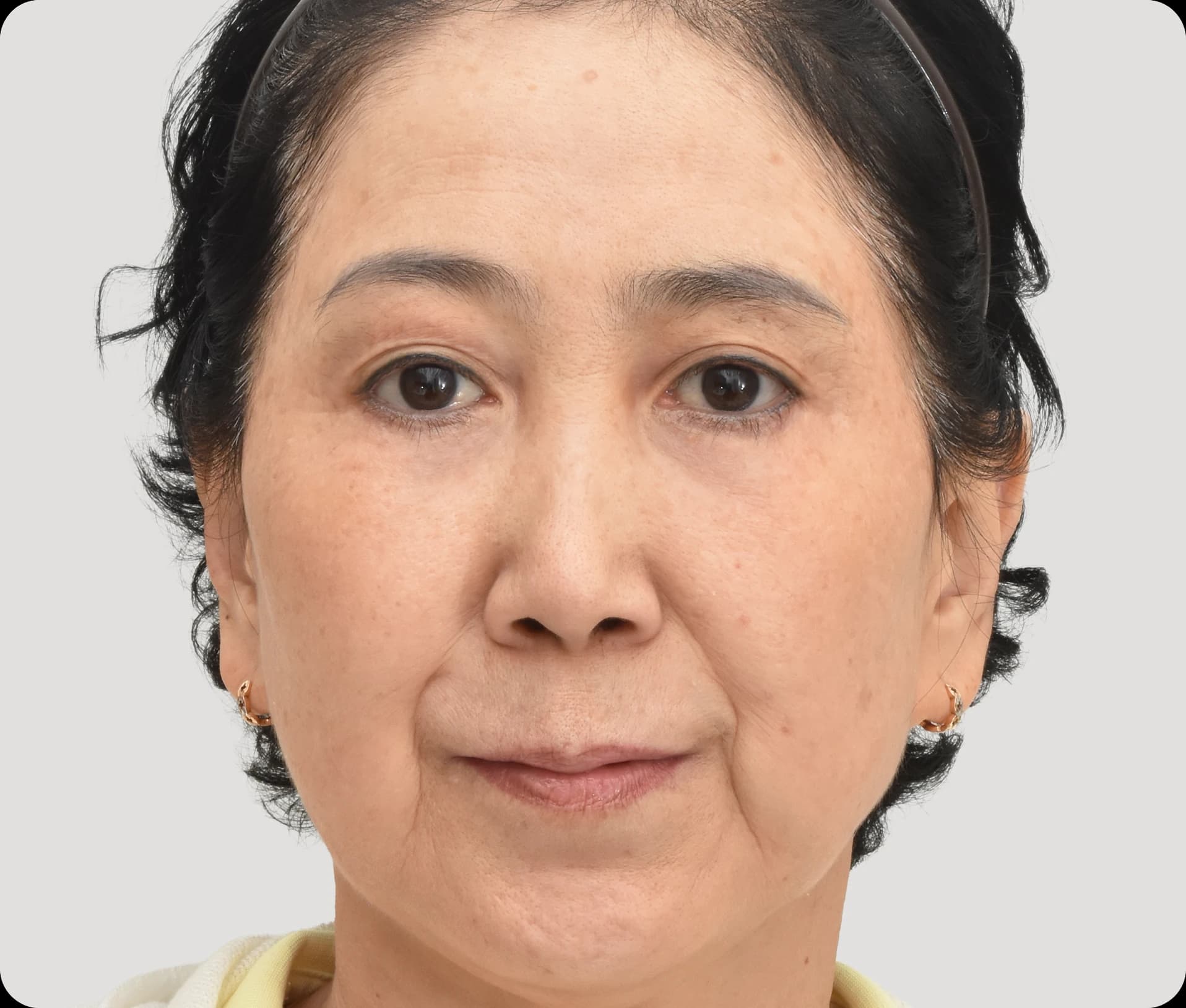하안검 및 지방이식 수술 후 - 눈 밑 함몰이 채워지고 탄력 있는 피부로 개선된 모습