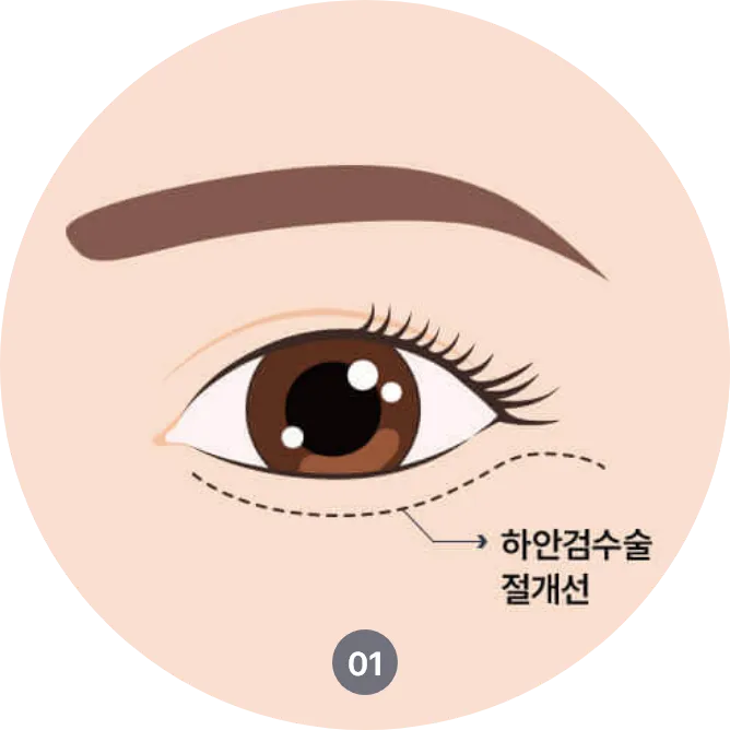 하안검수술 절개위치와 지방 재배치 방법 안내