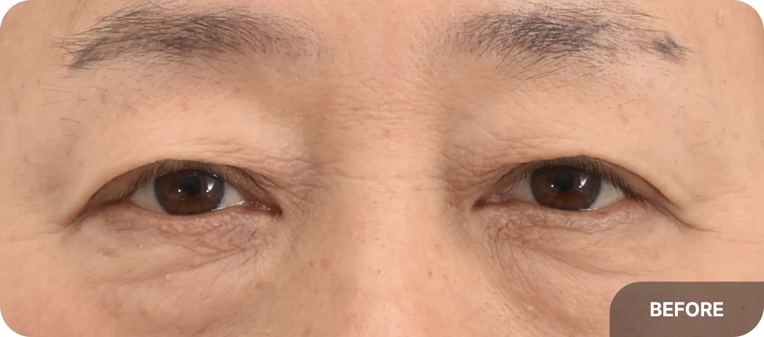 Aging lower eyelids with wrinkles and puffiness - common signs of aging