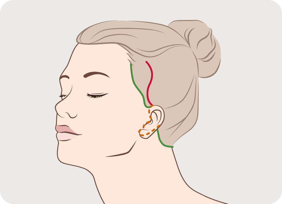 완벽주의 안면거상