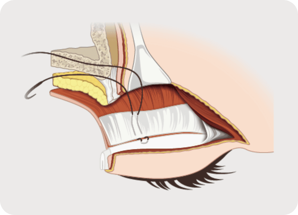 정교한 눈매교정