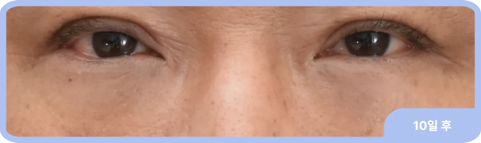 피부 탄력이 좋아 피부 절개 없이 눈밑지 만으로도 잘 치료된 사례