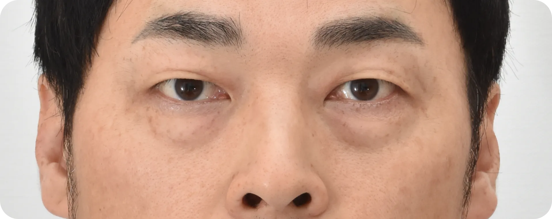 Before surgery - eyebags and depression are signs of lower lid aging