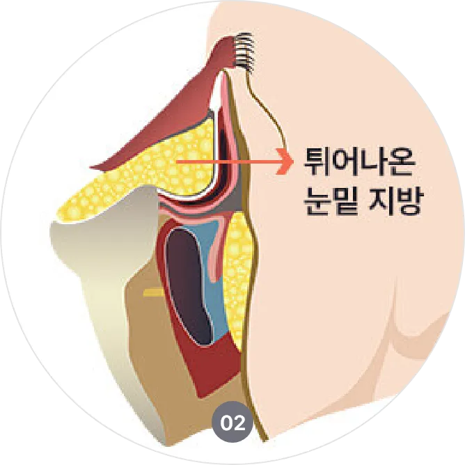 눈밑지방재배치 수술 방법 안내